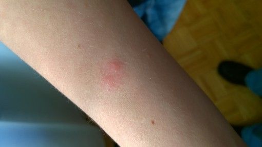 Amy's bedbug bites