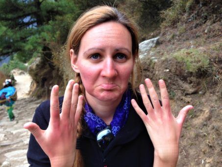 Showing off sunburnt hands while hiking to Everest Base Camp, Nepal